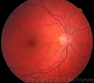 photo-back-eye-retina-434