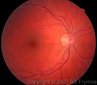 back of an eyeball showing optic nerve