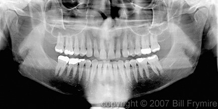 digiatl panoramic teeth x-ray model released