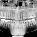 panoramic dental x-ray